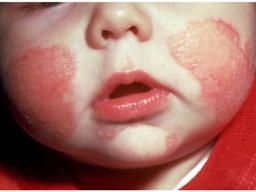 Аллергия у детей до года