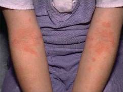 Дерматиты у детей (аллергия на коже)