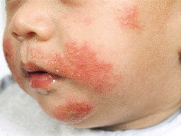 Аллергия у детей. Причины аллергии у ребенка.