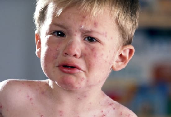 Сыпь при краснухе у детей: основные симптомы и лечение краснухи.